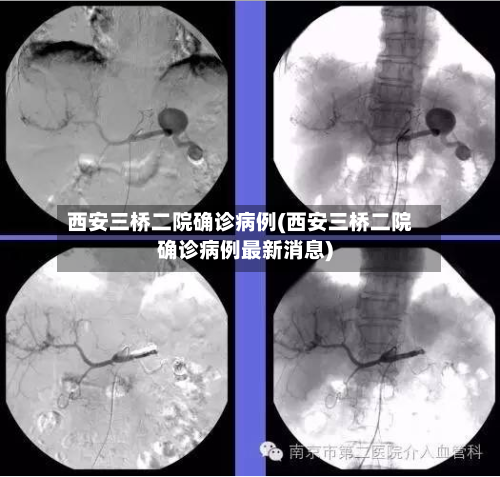 西安三桥二院确诊病例(西安三桥二院确诊病例最新消息)-第2张图片