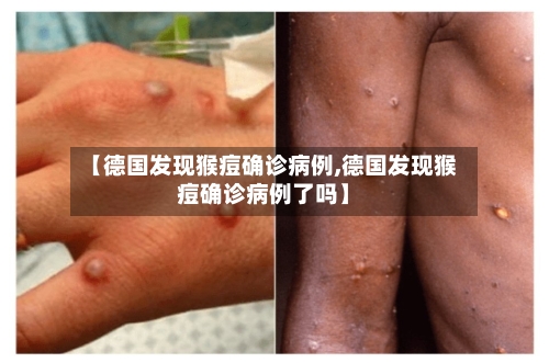 【德国发现猴痘确诊病例,德国发现猴痘确诊病例了吗】-第3张图片