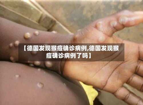 【德国发现猴痘确诊病例,德国发现猴痘确诊病例了吗】-第2张图片