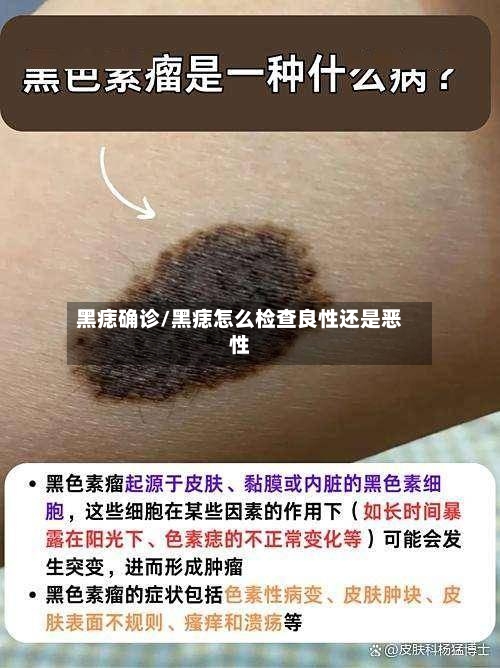 黑痣确诊/黑痣怎么检查良性还是恶性