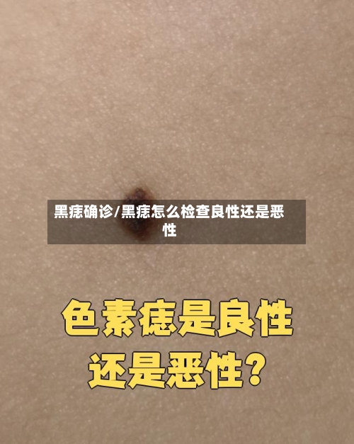 黑痣确诊/黑痣怎么检查良性还是恶性-第2张图片