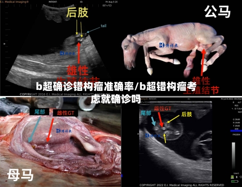 b超确诊错构瘤准确率/b超错构瘤考虑就确诊吗
