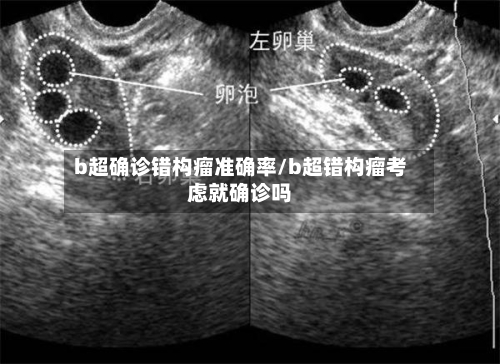 b超确诊错构瘤准确率/b超错构瘤考虑就确诊吗-第3张图片