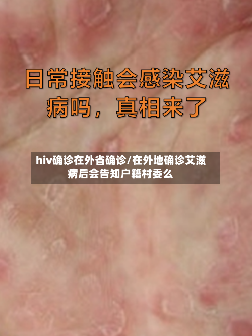 hiv确诊在外省确诊/在外地确诊艾滋病后会告知户籍村委么-第2张图片