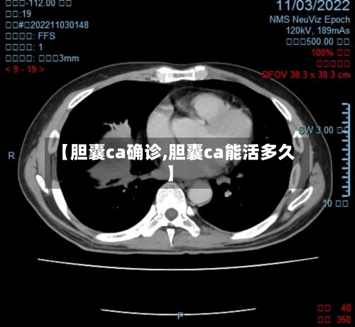 【胆囊ca确诊,胆囊ca能活多久】-第2张图片