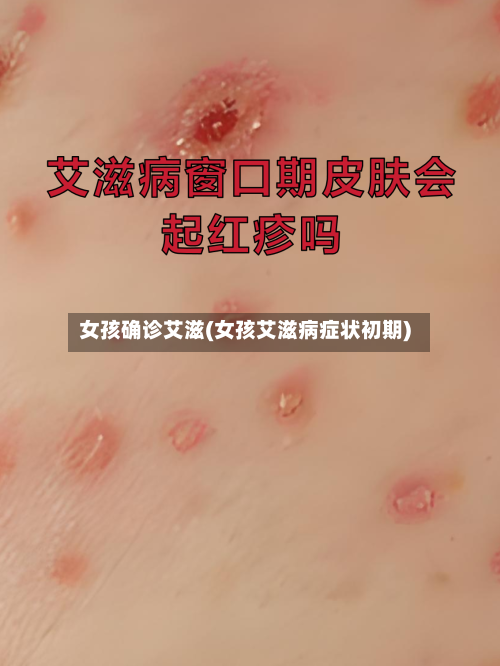 女孩确诊艾滋(女孩艾滋病症状初期)-第2张图片