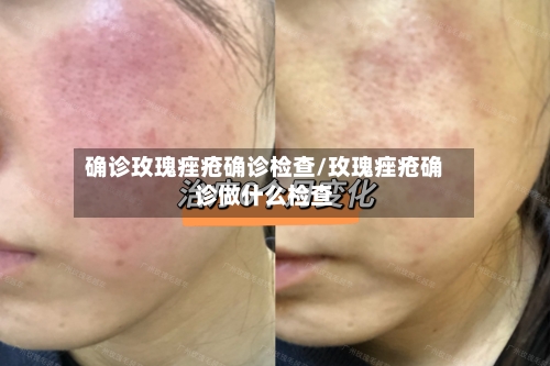 确诊玫瑰痤疮确诊检查/玫瑰痤疮确诊做什么检查-第1张图片