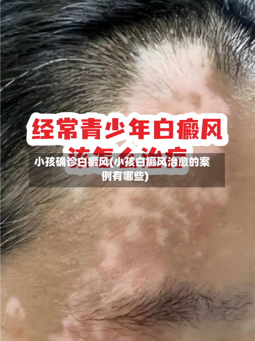 小孩确诊白癜风(小孩白癜风治愈的案例有哪些)