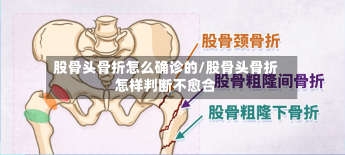 股骨头骨折怎么确诊的/股骨头骨折怎样判断不愈合