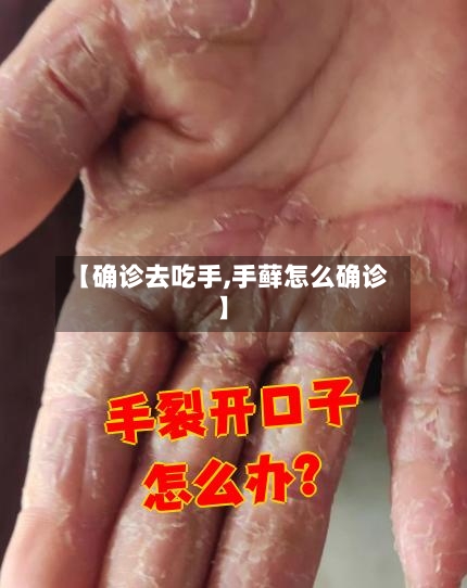 【确诊去吃手,手藓怎么确诊】