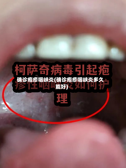 确诊疱疹咽峡炎(确诊疱疹咽峡炎多久能好)-第2张图片