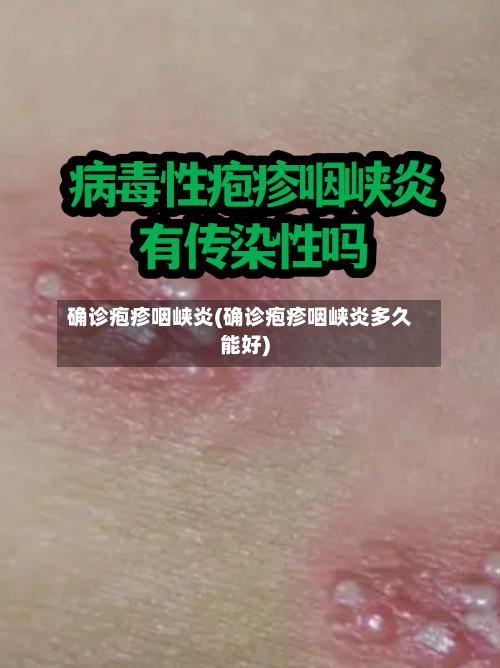 确诊疱疹咽峡炎(确诊疱疹咽峡炎多久能好)