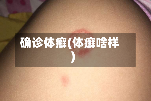 确诊体癣(体癣啥样)
