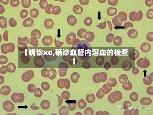 【确诊xo,确诊血管内溶血的检查】-第2张图片