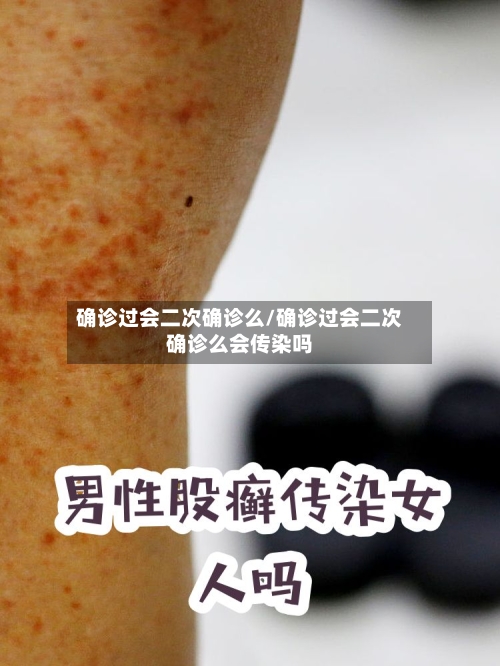 确诊过会二次确诊么/确诊过会二次确诊么会传染吗
