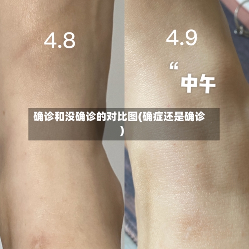 确诊和没确诊的对比图(确症还是确诊)