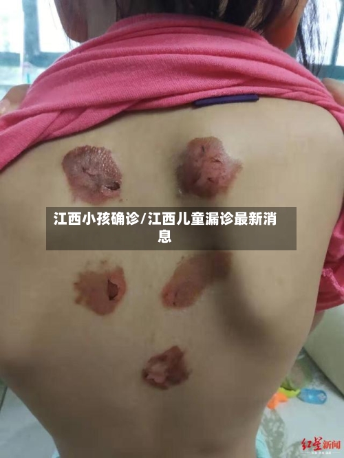 江西小孩确诊/江西儿童漏诊最新消息