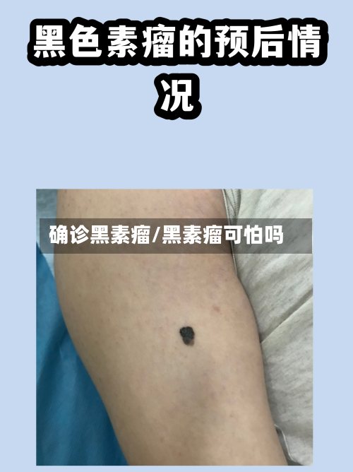 确诊黑素瘤/黑素瘤可怕吗