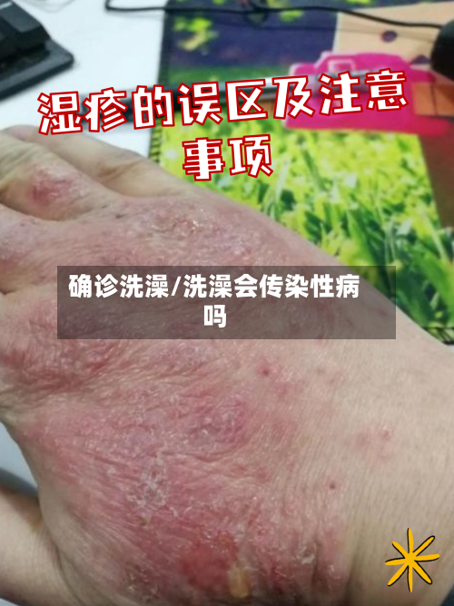 确诊洗澡/洗澡会传染性病吗