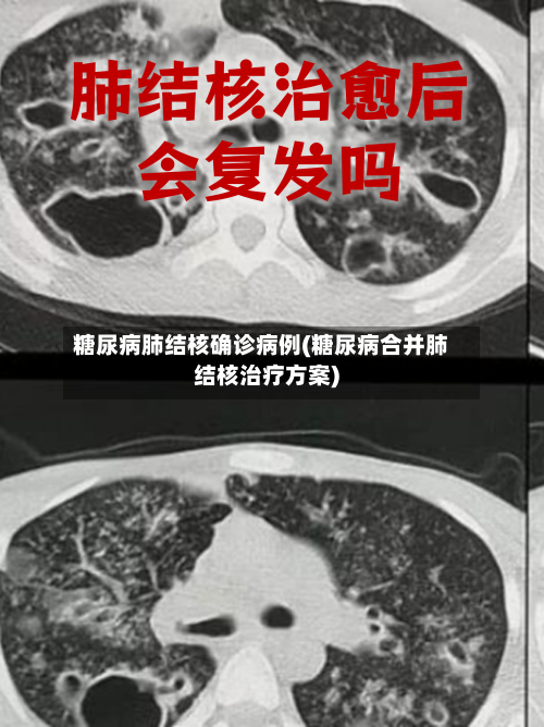 糖尿病肺结核确诊病例(糖尿病合并肺结核治疗方案)-第2张图片