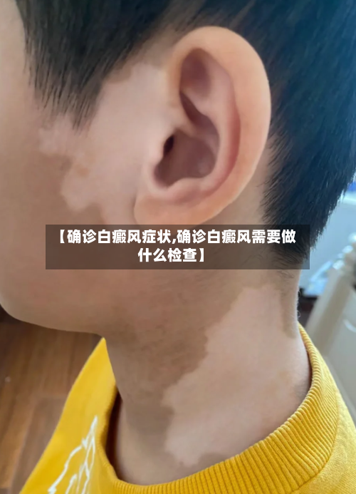 【确诊白癜风症状,确诊白癜风需要做什么检查】-第1张图片