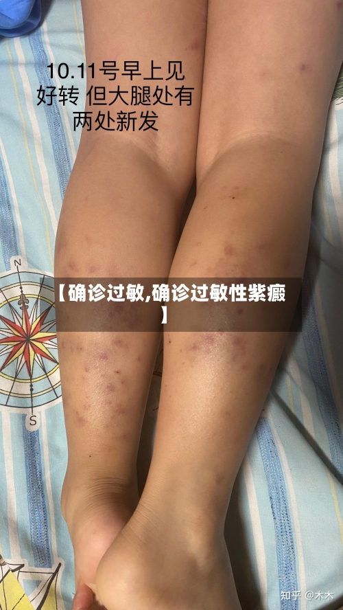 【确诊过敏,确诊过敏性紫癜】-第2张图片