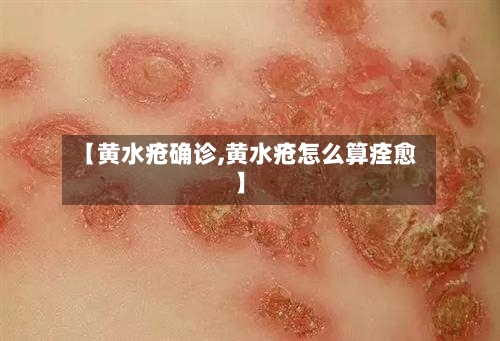 【黄水疮确诊,黄水疮怎么算痊愈】