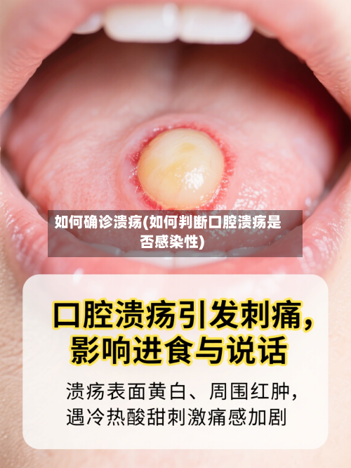 如何确诊溃疡(如何判断口腔溃疡是否感染性)