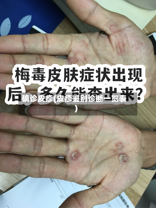 确诊皮疹(皮疹鉴别诊断一览表)