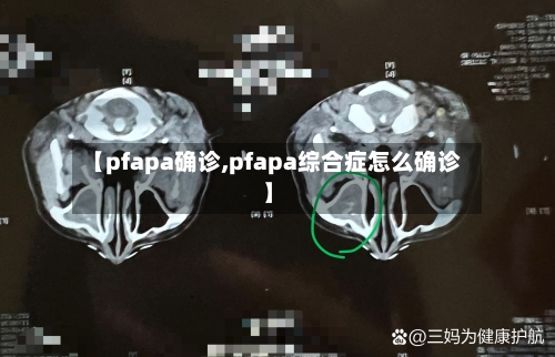 【pfapa确诊,pfapa综合症怎么确诊】