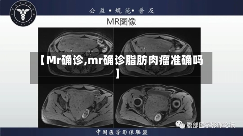 【Mr确诊,mr确诊脂肪肉瘤准确吗】
