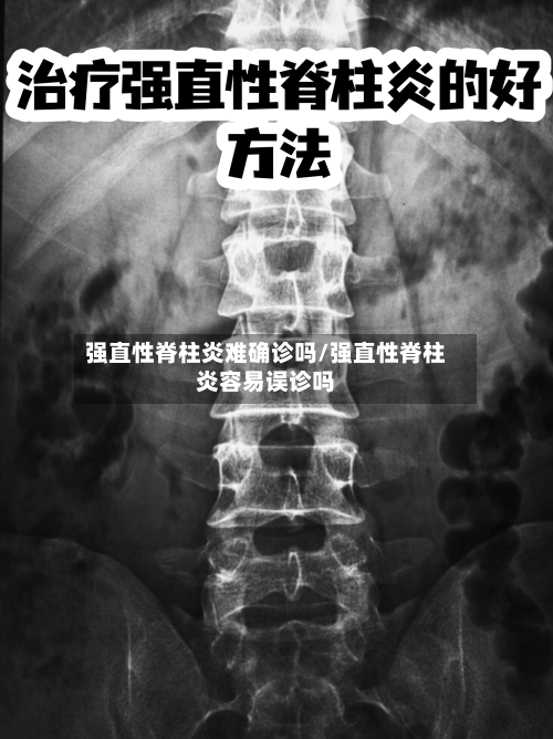 强直性脊柱炎难确诊吗/强直性脊柱炎容易误诊吗-第3张图片