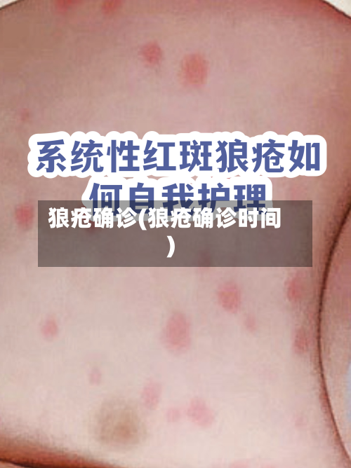 狼疮确诊(狼疮确诊时间)