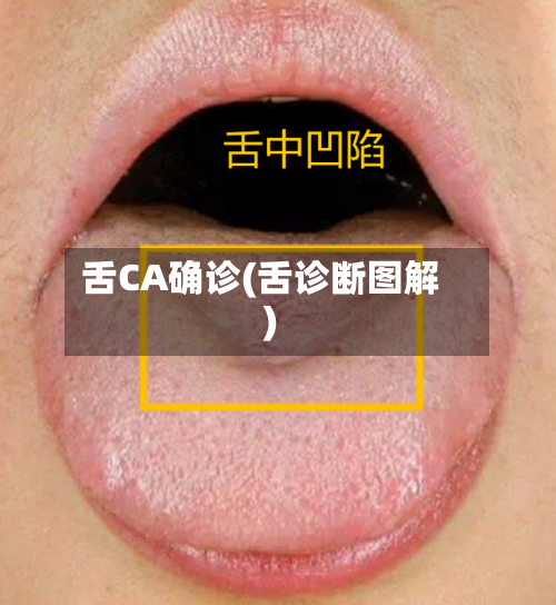 舌CA确诊(舌诊断图解)