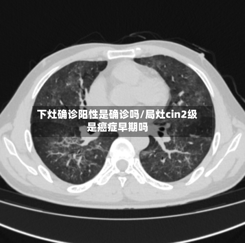 下灶确诊阳性是确诊吗/局灶cin2级是癌症早期吗-第2张图片