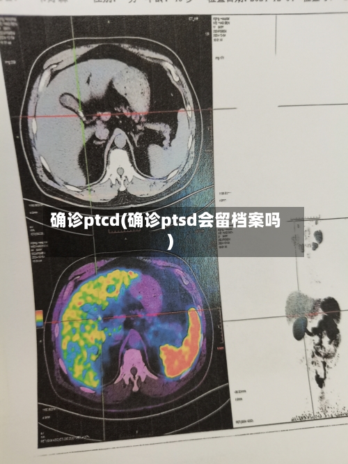 确诊ptcd(确诊ptsd会留档案吗)