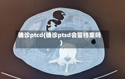 确诊ptcd(确诊ptsd会留档案吗)-第3张图片