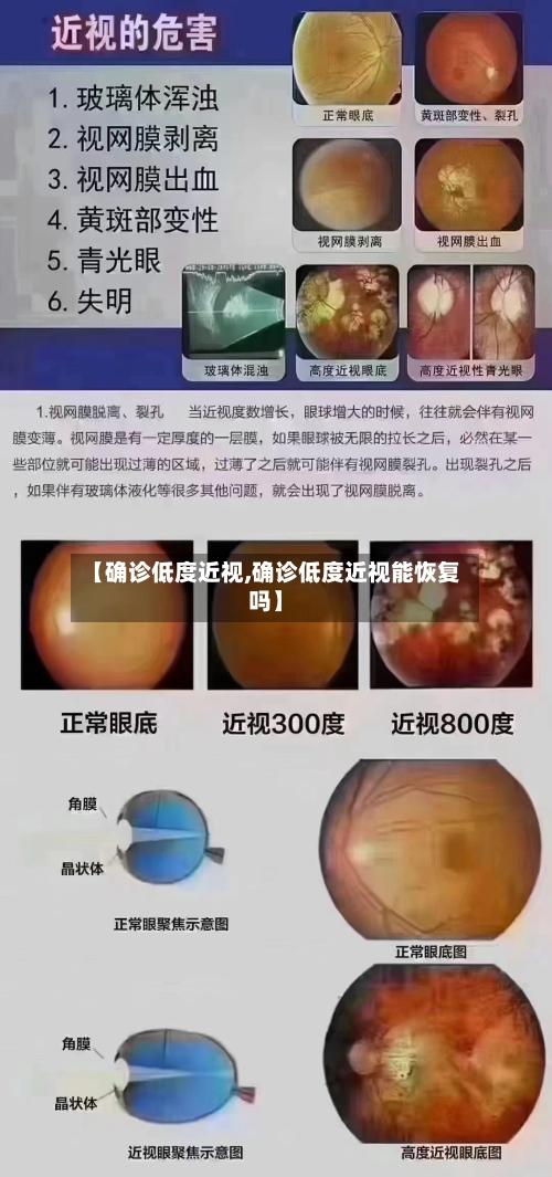 【确诊低度近视,确诊低度近视能恢复吗】-第3张图片