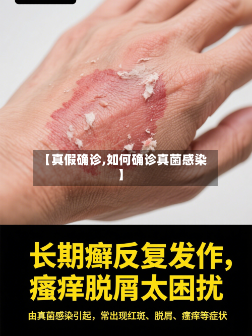 【真假确诊,如何确诊真菌感染】-第2张图片