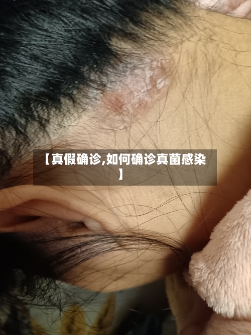 【真假确诊,如何确诊真菌感染】