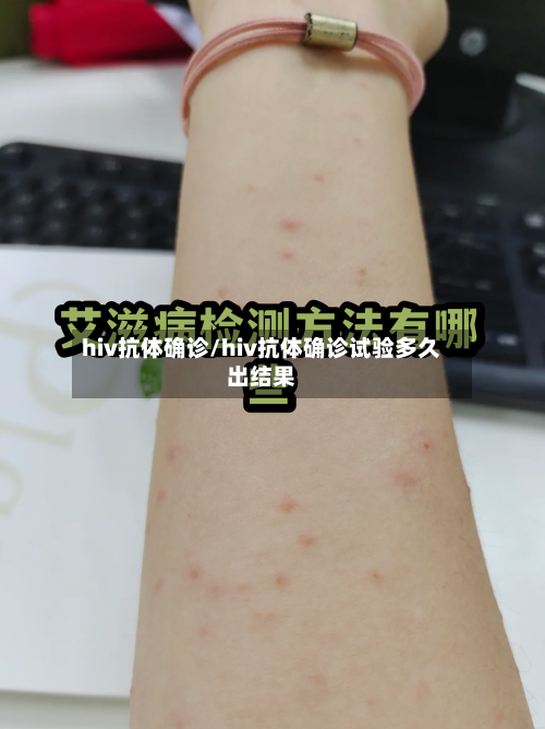 hiv抗体确诊/hiv抗体确诊试验多久出结果