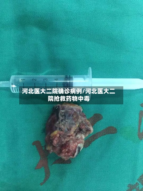 河北医大二院确诊病例/河北医大二院抢救药物中毒-第2张图片