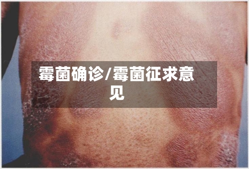 霉菌确诊/霉菌征求意见-第2张图片