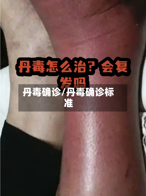 丹毒确诊/丹毒确诊标准-第2张图片