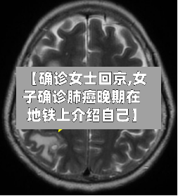 【确诊女士回京,女子确诊肺癌晚期在地铁上介绍自己】