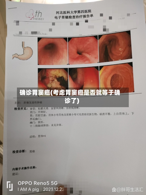 确诊胃窦癌(考虑胃窦癌是否就等于确诊了)-第2张图片